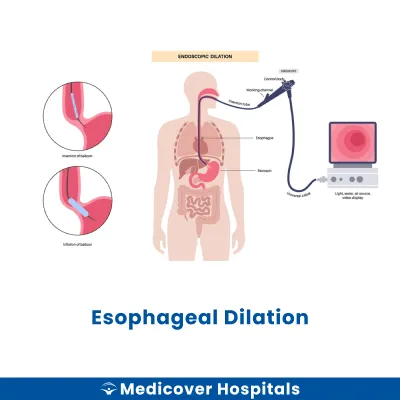 Esophageal Dilation