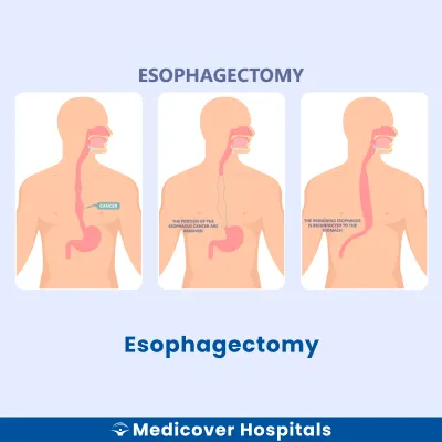 Esophagectomy