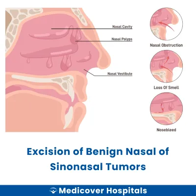 Excision of Benign Nasal of Sinonasal Tumors