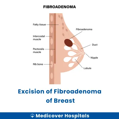 Excision of Fibroadenoma of Breast