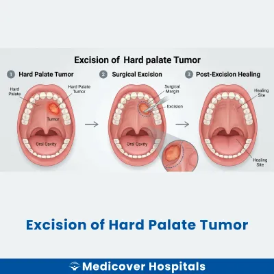 Excision of Hard Palate Tumor