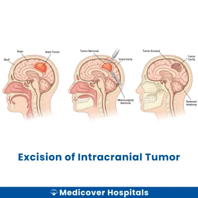 Excision of Intracranial Tumor
