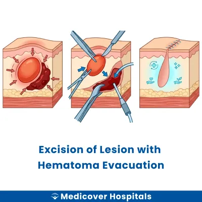 Excision of Lesion With Hematoma Evacuation