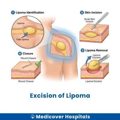 Excision of Lipoma