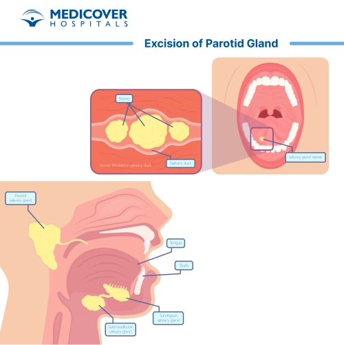 Excision of Parotid Gland
