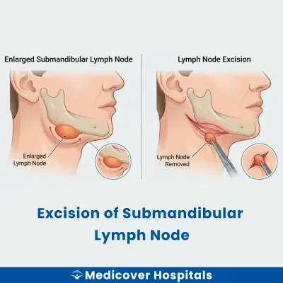 Excision of Submandibular Lymph Node