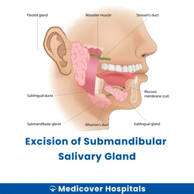 Excision of Submandibular Salivary Gland