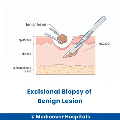 Excisional Biopsy of Benign Lesion