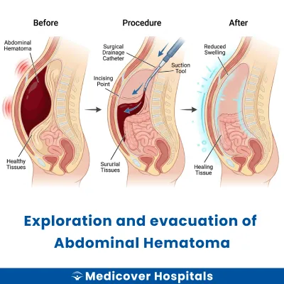 Exploration and Evacuation of Abdominal Hematoma