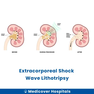 Extracorporeal Shock Wave Lithotripsy