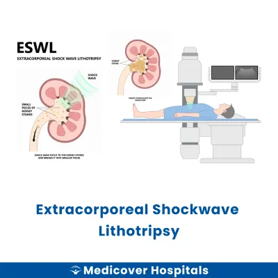 Extracorporeal Shockwave Lithotripsy