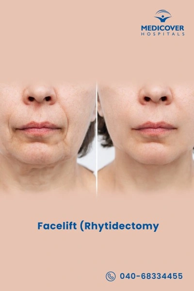 facelift-rhytidectomy