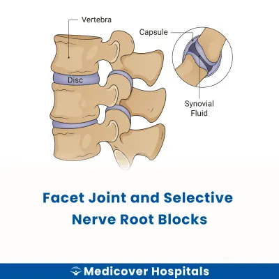 Facet Joint and Selective Nerve Root Blocks
