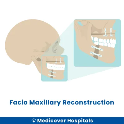 Facio Maxillary Reconstruction