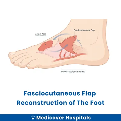 Fasciocutaneous Flap Reconstruction of The Foot