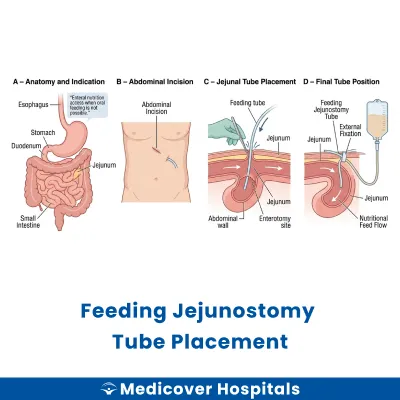 Feeding Jejunostomy Tube Placement