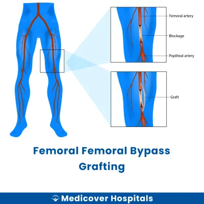 Femoral Femoral Bypass Grafting
