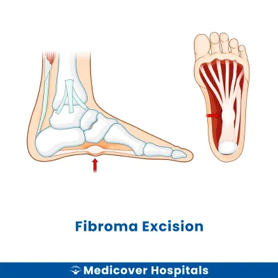 Fibroma Excision