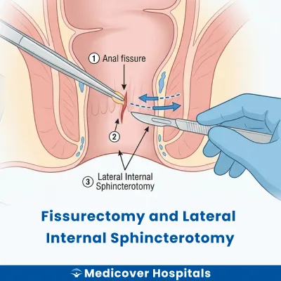Fissurectomy and Lateral Internal Sphincterotomy
