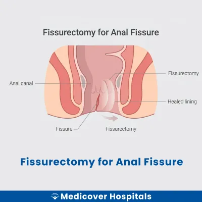 Fissurectomy for Anal Fissure