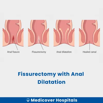 Fissurectomy With Anal Dilatation