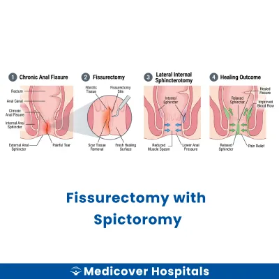 Fissurectomy With Spictoromy