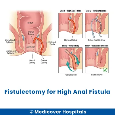 Fistulectomy for High Anal Fistula