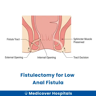 Fistulectomy for Low Anal Fistula