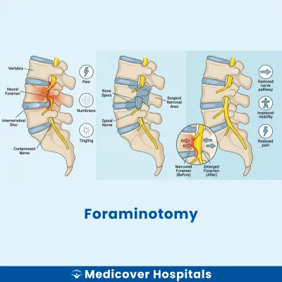 Foraminotomy