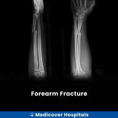 Forearm Fracture