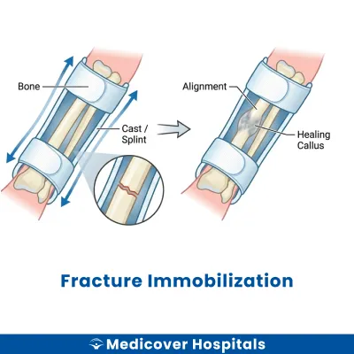 Fracture Immobilization