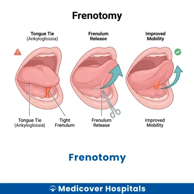 Frenotomy