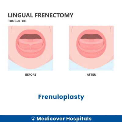Frenuloplasty