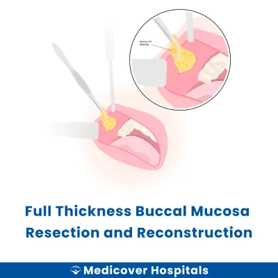 Full Thickness Buccal Mucosa Resection and Reconstruction