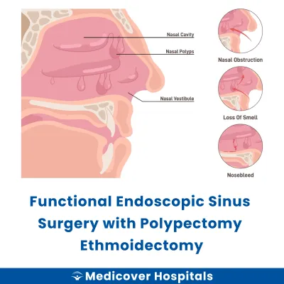 Functional Endoscopic Sinus Surgery With Polypectomy Ethmoidectomy