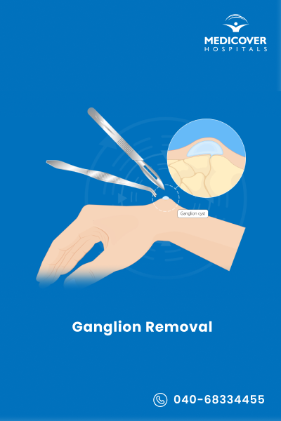 Ganglion Removal