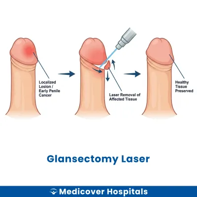 Glansectomy Laser