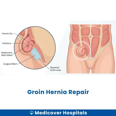 Groin Hernia Repair