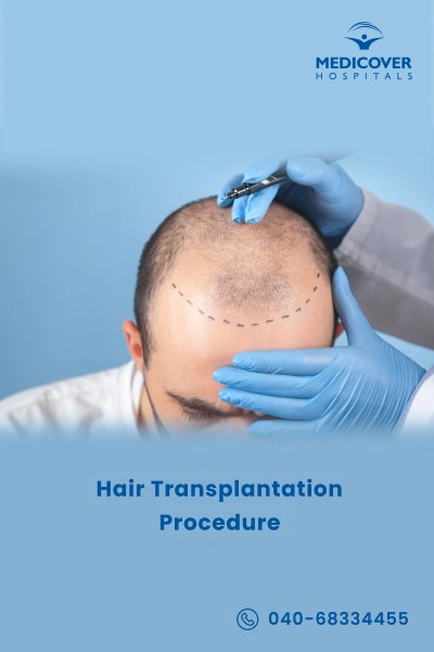 hair-transplantation