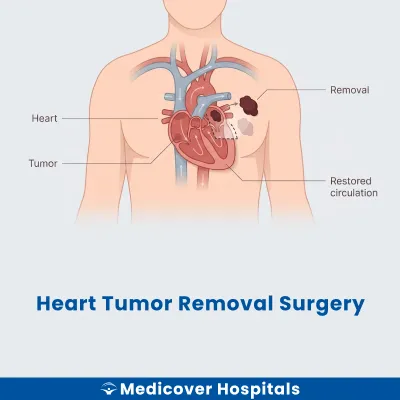 Heart Tumor Removal Surgery