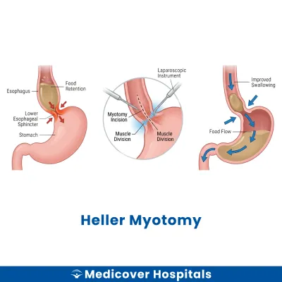 Heller Myotomy