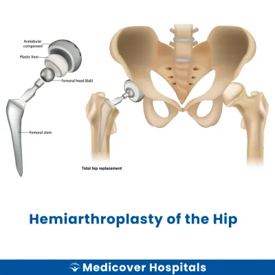 Hemiarthroplasty of The Hip