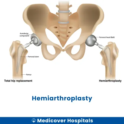 Hemiarthroplasty