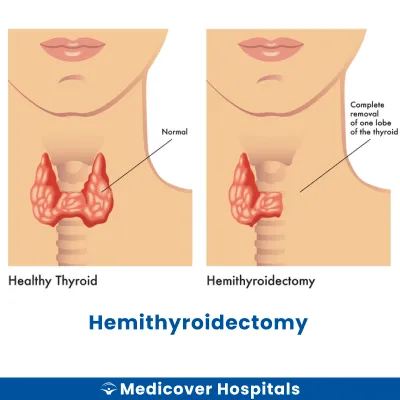 Hemithyroidectomy
