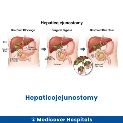 Hepaticojejunostomy