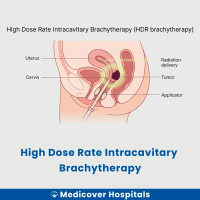 High Dose Rate Intracavitary Brachytherapy