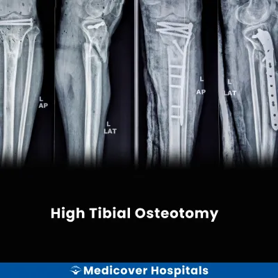 High Tibial Osteotomy