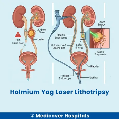 Holmium Yag Laser Lithotripsy