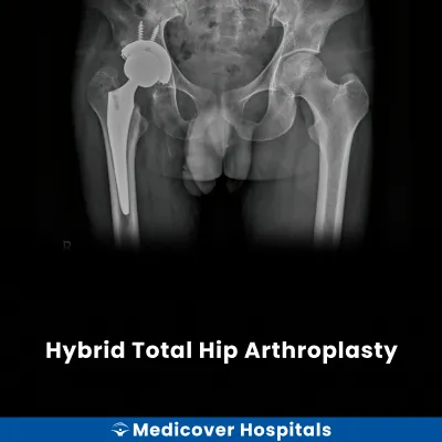 Hybrid Total Hip Arthroplasty