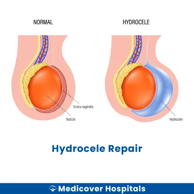 Hydrocele Repair